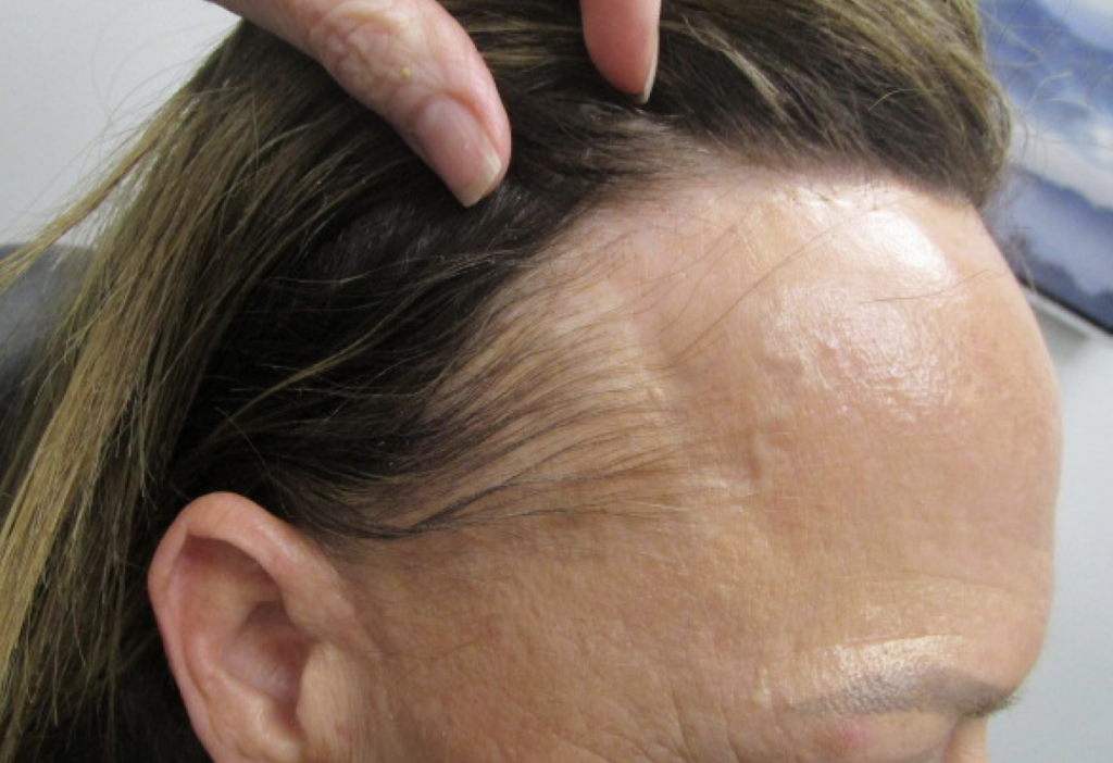 A New Epidemic Frontal Fibrosing Alopecia Skin Bones Cme