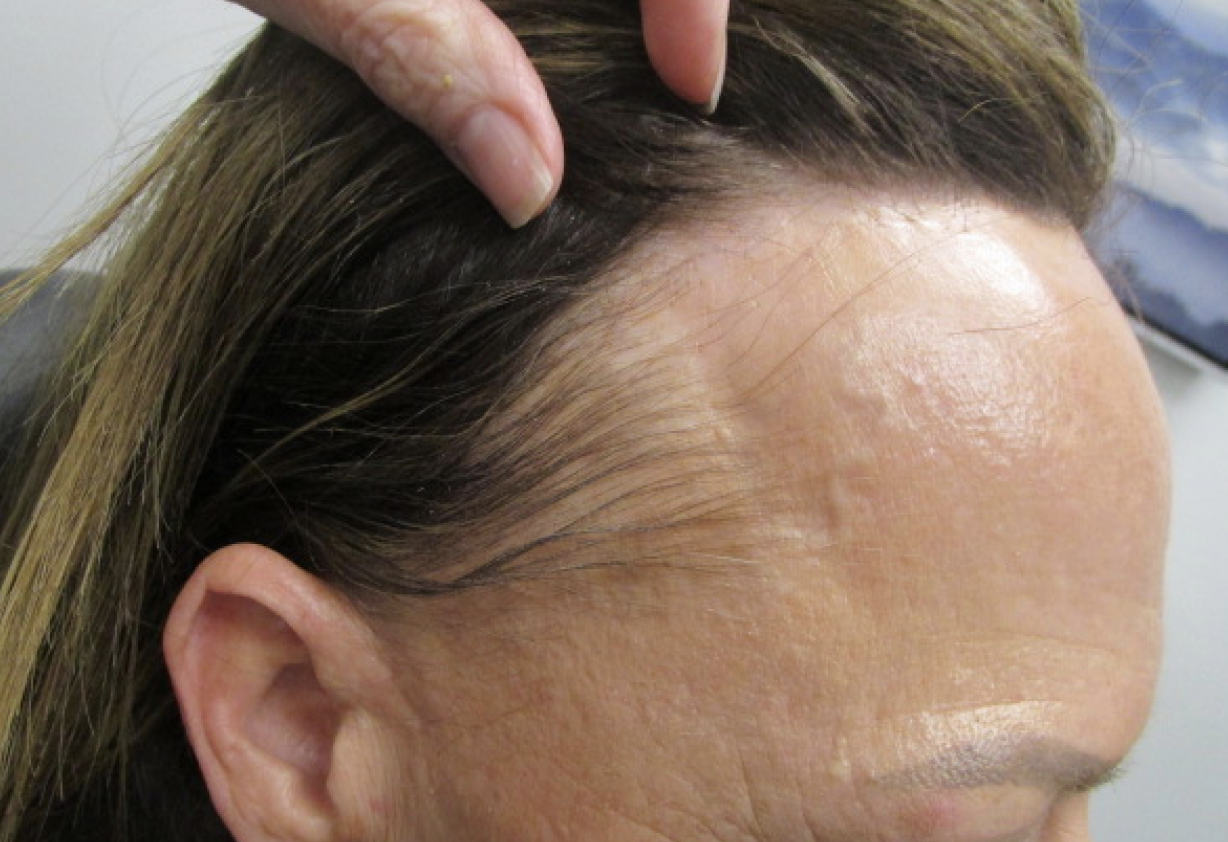 A New Epidemic: Frontal Fibrosing Alopecia | Skin Bones CME